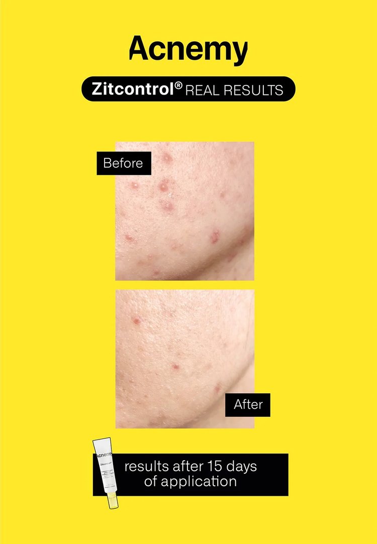 Tratamiento Diario Anti Imperfecciones 40 ml - Acnemy